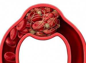 Cục máu đông: Nguyên nhân, biểu hiện và cách ngăn ngừa cục máu đông